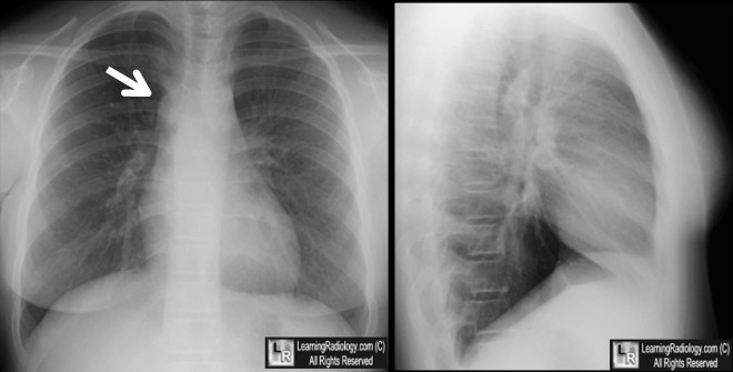 Interruption of Inferior Vena Cava (IVC)